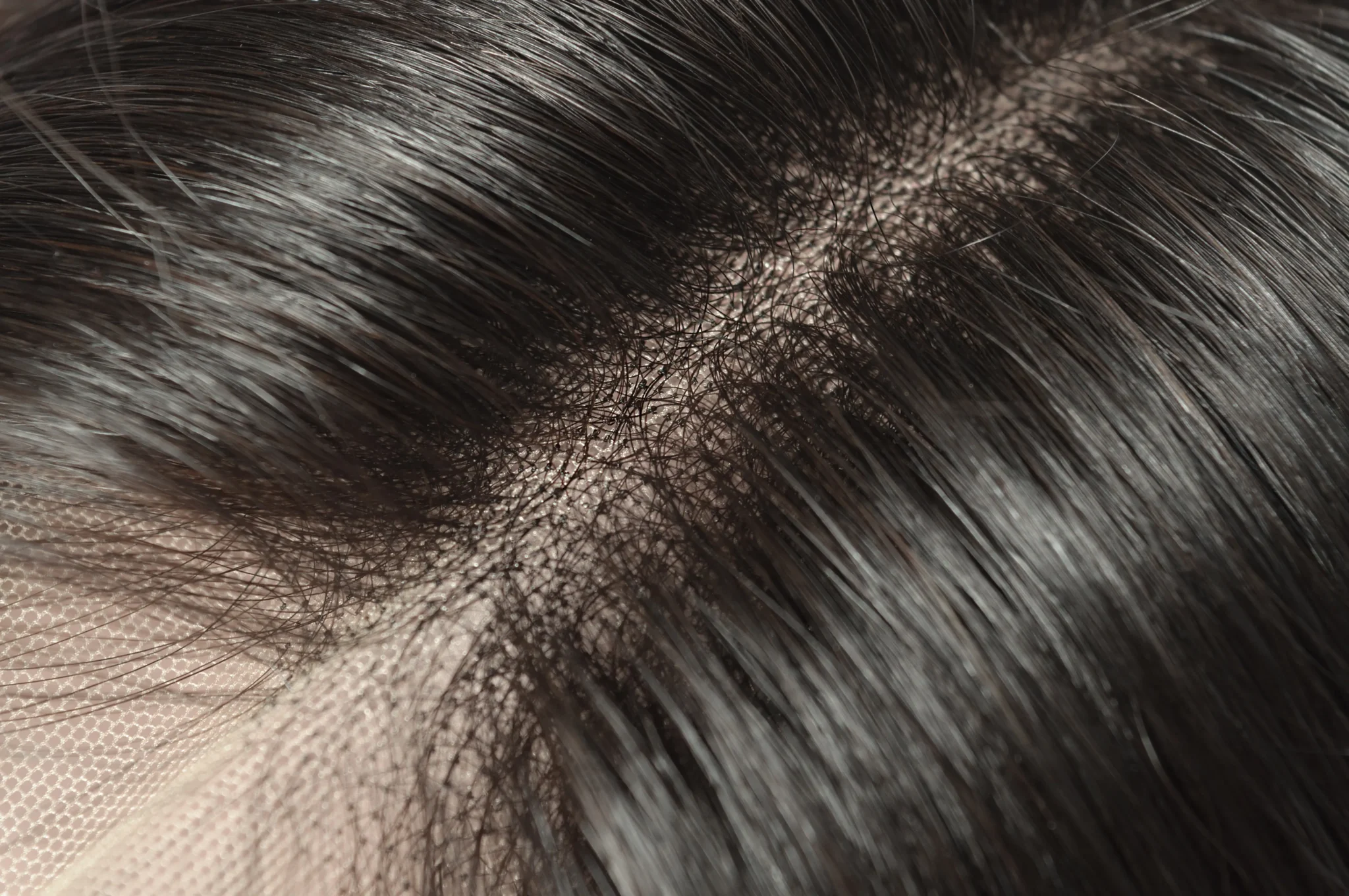 Haarausfall - VISAGE Hair & Beauty - Perücken München - Haarteile, Perücken & Microbondings